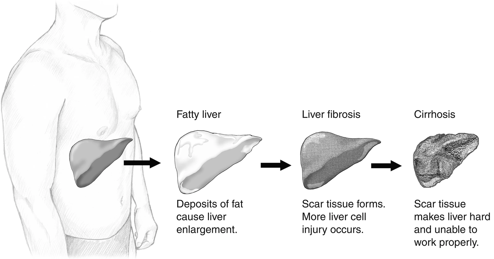 Illustration of liver fat accumulation and scarring. Credit: National Institute of Diabetes and Digestive and Kidney Diseases, National Institutes of Health.